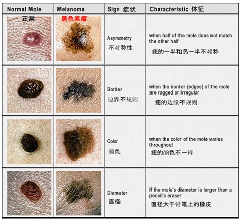 灰色痣|有这5种“痣”要小心，可能会恶变